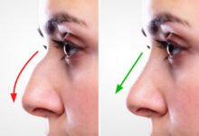 Rhinoplasty in Dubai