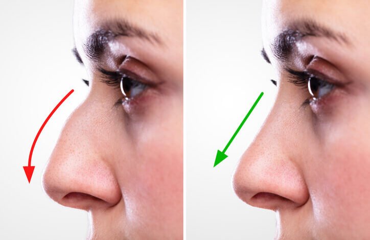 Rhinoplasty in Dubai