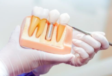 Exploring the Steps of Tooth Replacement