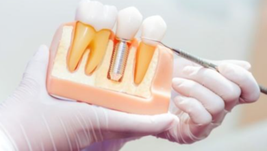 Exploring the Steps of Tooth Replacement