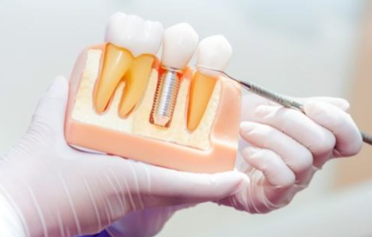 Exploring the Steps of Tooth Replacement