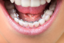 Exploring Affordable Braces and How They Can Straighten Your Smile