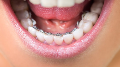 Exploring Affordable Braces and How They Can Straighten Your Smile