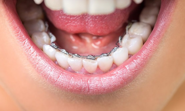 Exploring Affordable Braces and How They Can Straighten Your Smile